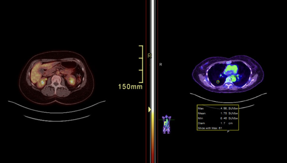 PET Scanner